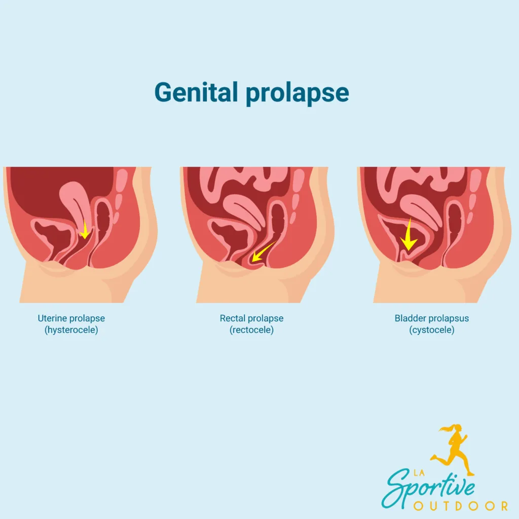 genital-prolapse