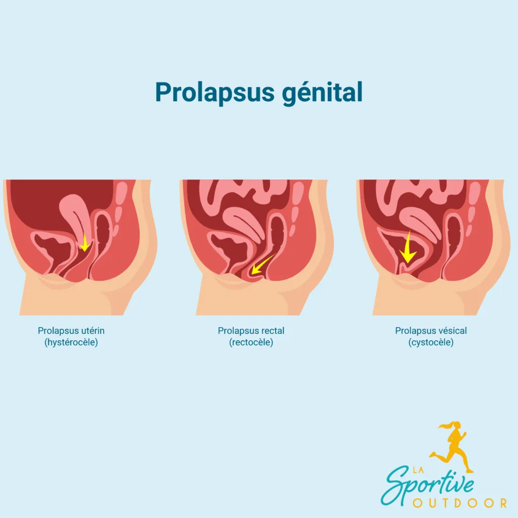 prolapsus-genital