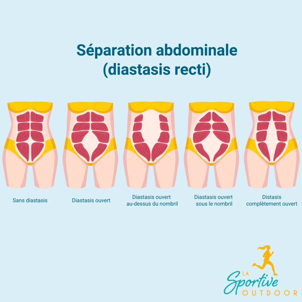 separation-abdominale